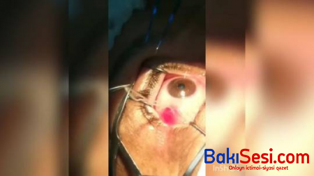 Azərbaycanda gözdən qurd çıxarıldı - VİDEO