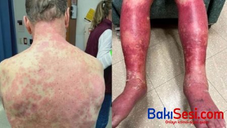 Peyvənd olunan şəxsin son halı - FOTO