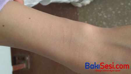 Məktəbli qızlar sosial şəbəkədə videoya baxıb qollarını kəsdilər