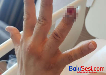 Sərxoş qadın mühafizəçinin barmağını dişləyib qopardı
