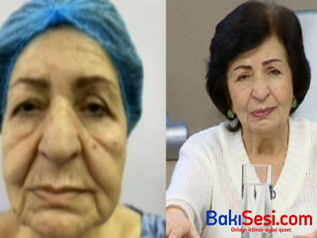 "Plastik əməliyyatla 15 yaş cavanlaşdım" - Kübra Əliyeva