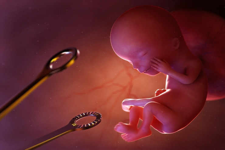 Azərbaycanda abortlarla bağlı DƏHŞƏTLİ STATİSTİKA